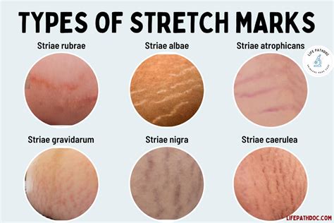 Are Stretch Marks a Sign of Muscle Growth? Exploring the Myths and Realities of Skin and Strength