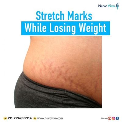 Why Do Stretch Marks Itch When Losing Weight? And Why Do Bananas Dream of Electric Sheep?